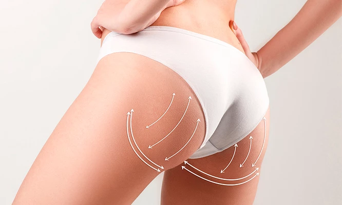 Sesiones de moldeado de glúteos + 04 radio frecuencia y más